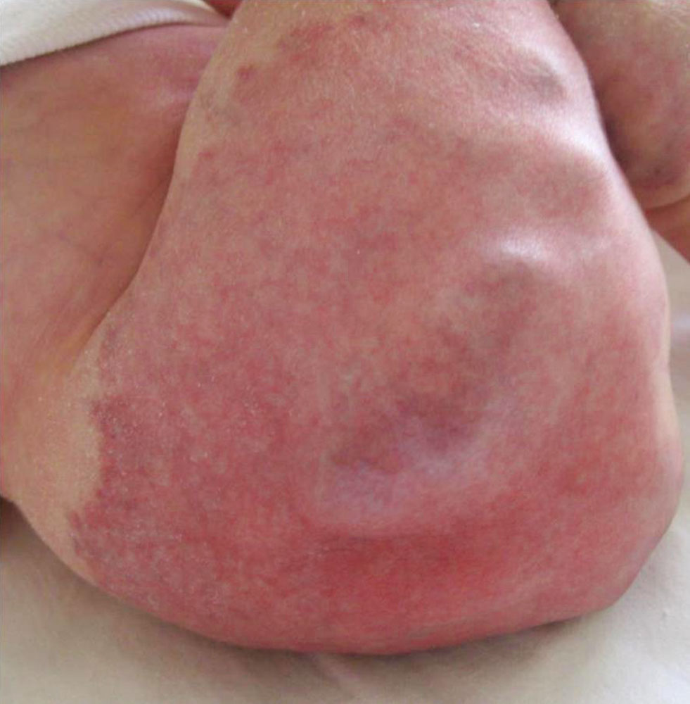 Kombinierte kapillär-venöse Malformation bei Säugling