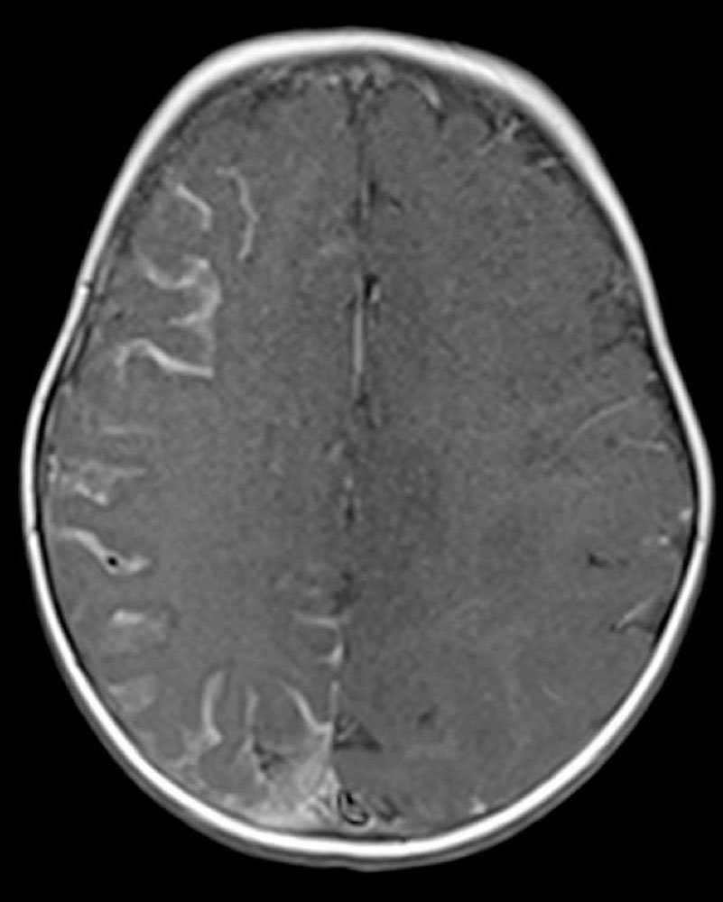 MRT von Schädel – Kleinkind mit Sturge-Weber-Syndrom