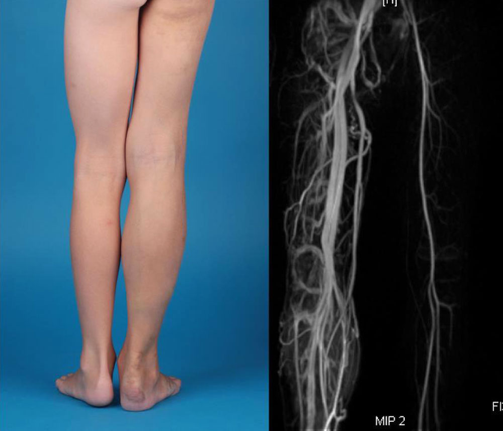 Patient mit Parkes-Weber-Syndrom