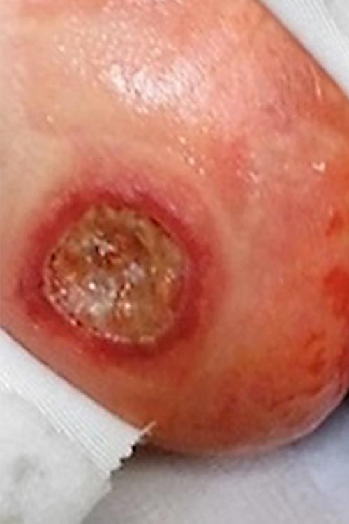 Ulzeriertes Hämangiom an Gesäßhälfte bei Säugling