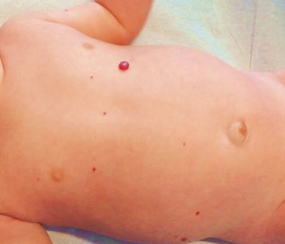 Säugling mit multifokalem Infantilem Hämangiom