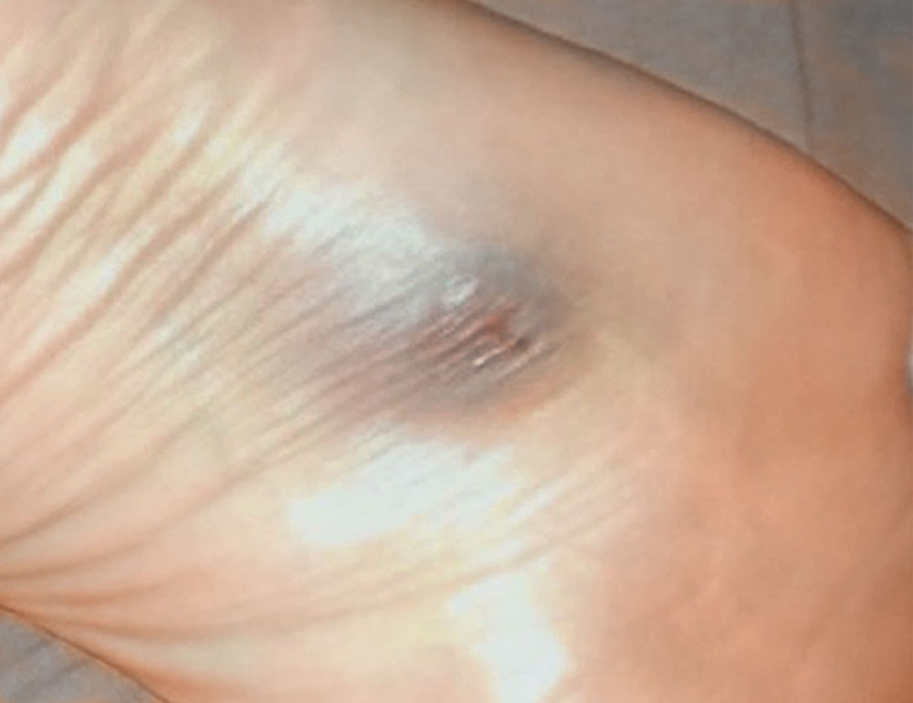 Spindelzellhämangiom an Fuß