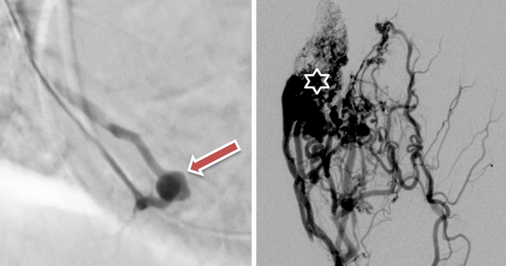Angiographie – Arteriovenöse Fistel