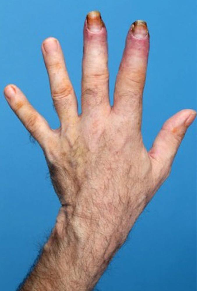 Phlebödem an Hand