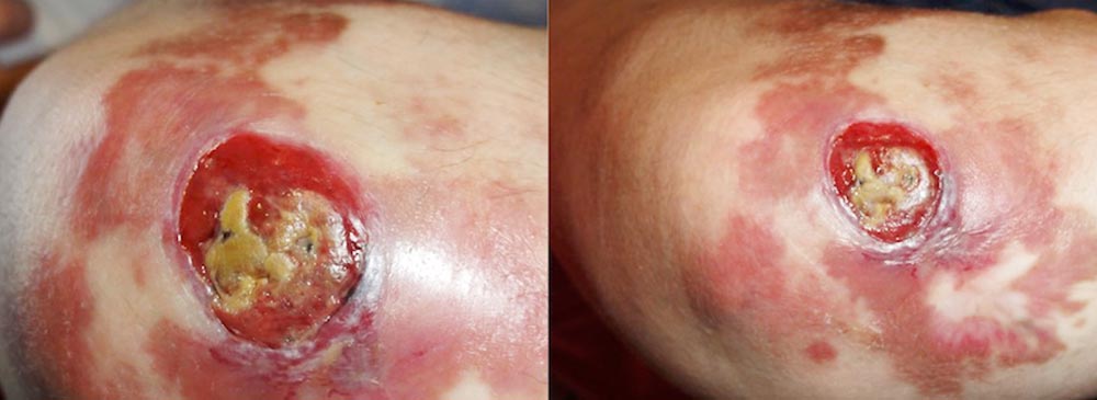 Chronische Ulceration an Kniescheibe