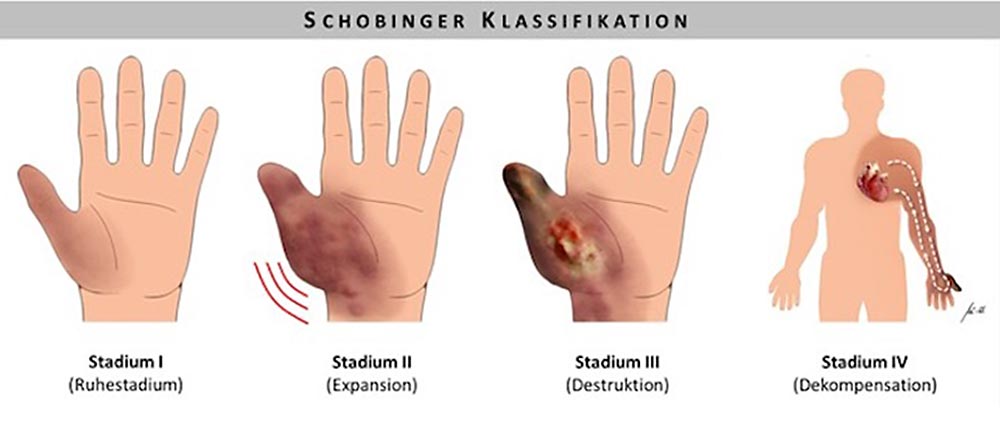 Grafik – Schobinger-Klassifikation