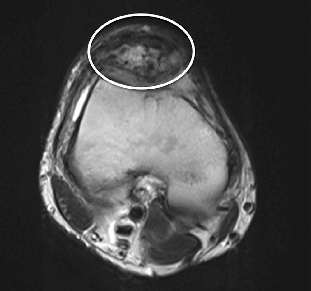MRT der Patella