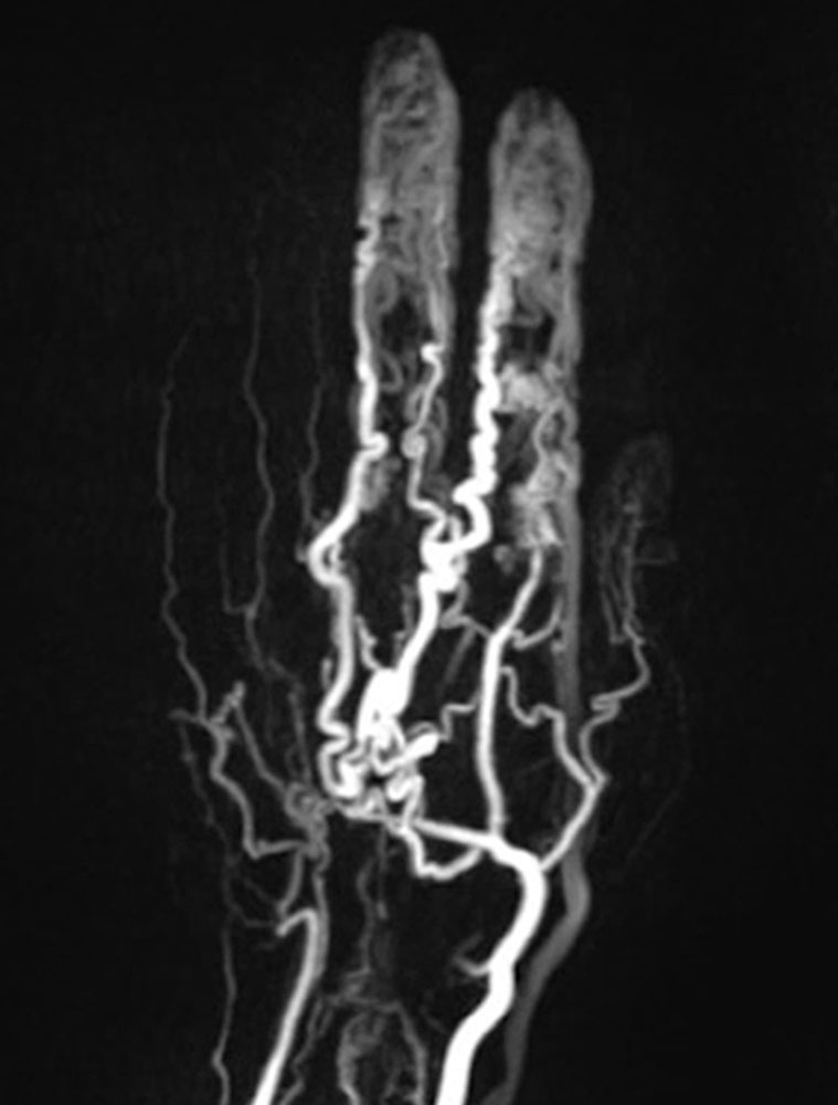 Angiographie der Hand