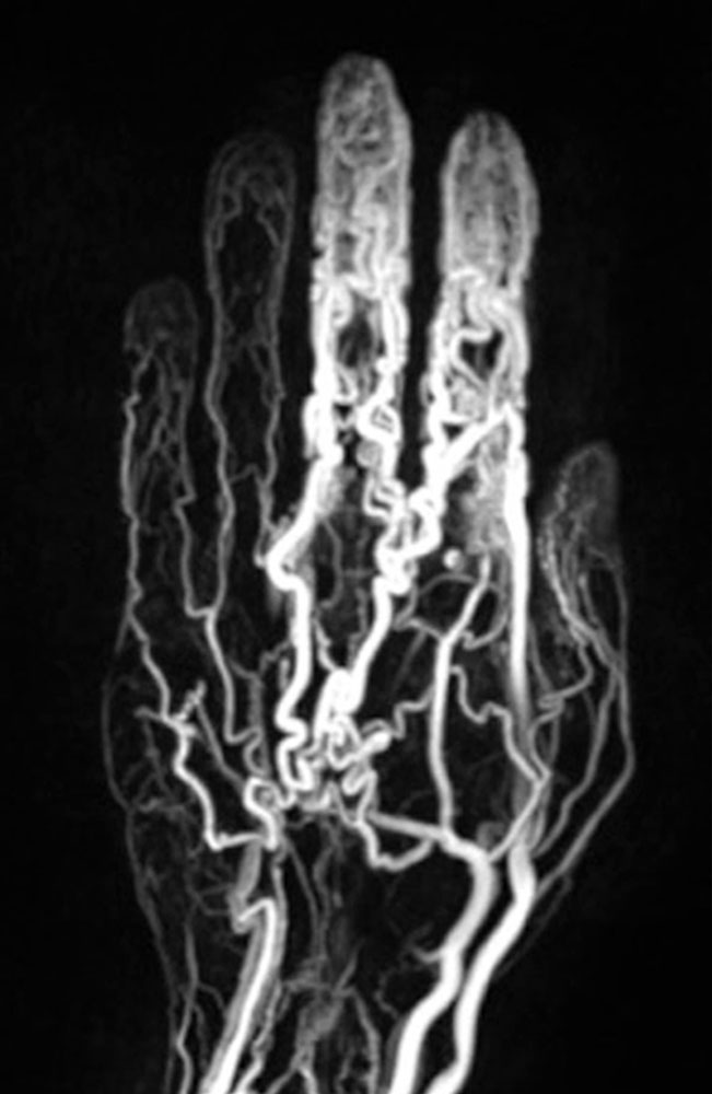 Angiographie der Hand