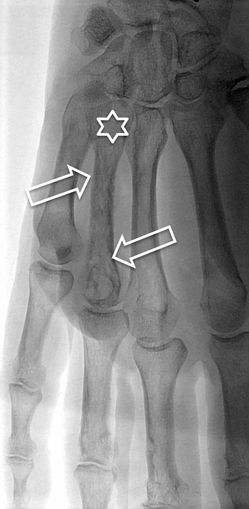 Röntgenaufnahme – Arteriovenöse Malformation