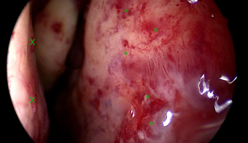 Endoskopisches Bild bei HHT-Morbus Osler