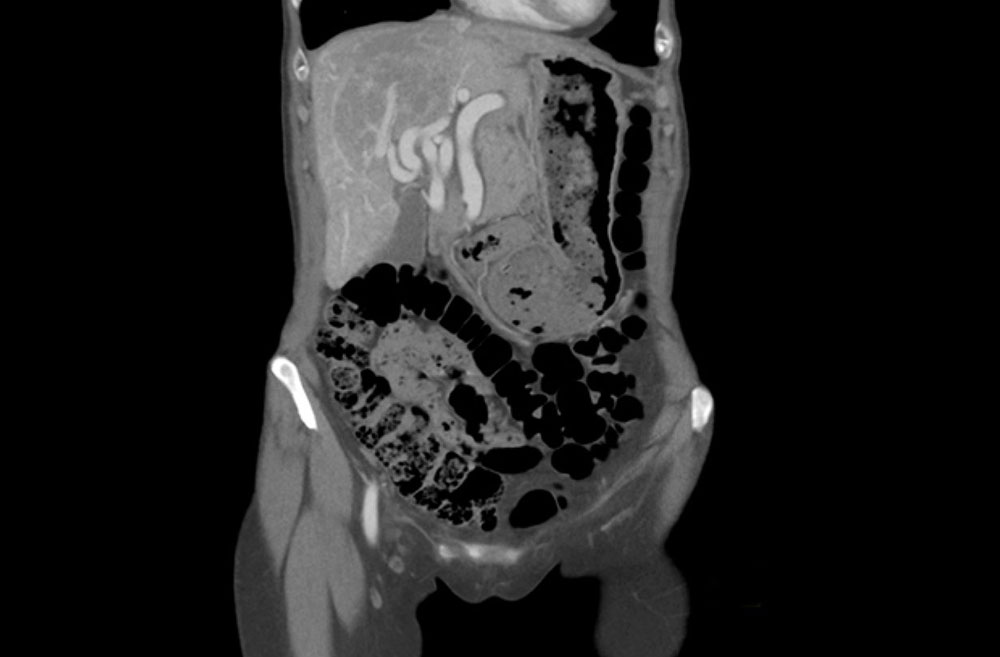 massiv dilatierter Leberarterie