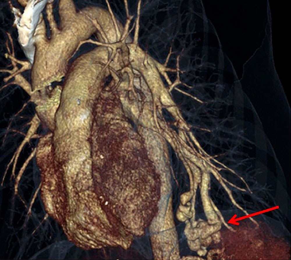 3D Computertomographie der Lunge nach Kontrastmittel