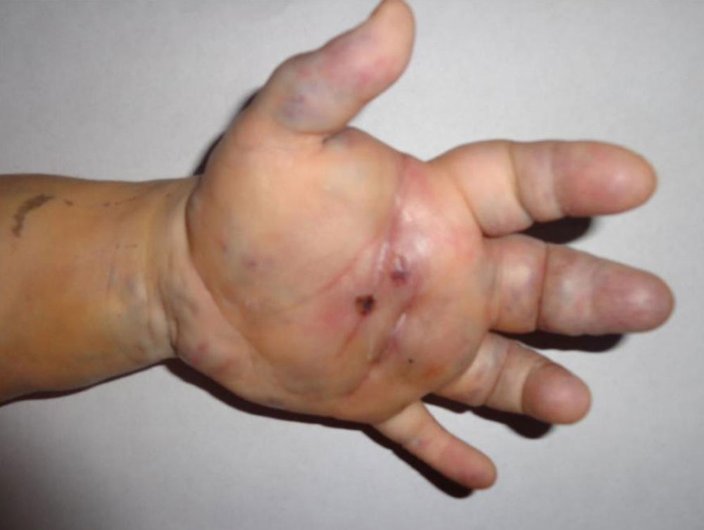 Hand mit einer ausgedehnten venösen Malformation