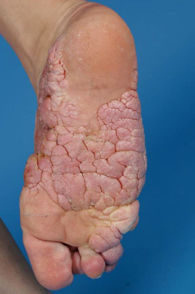 Cerebriform Mixed Connective Tissue Nevus an der Fusssohle - Mokkasinsohle