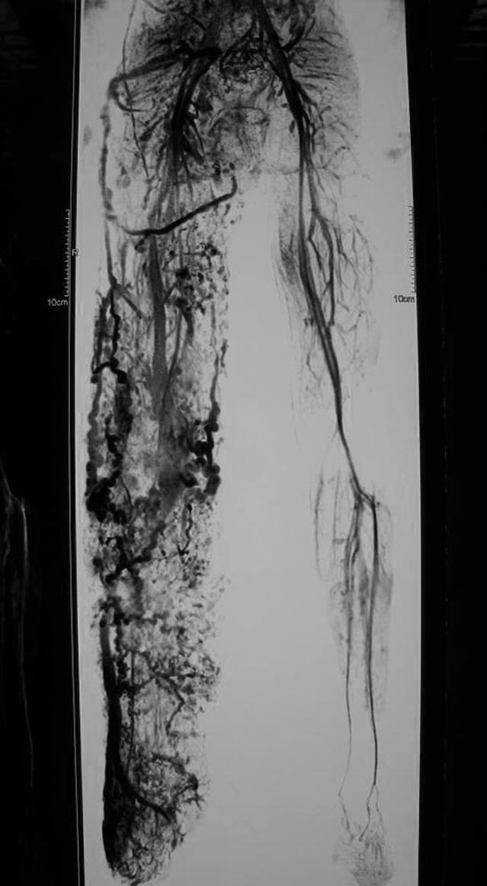 MR-Angiographie bei Klippel-Trénaunay-Syndrom