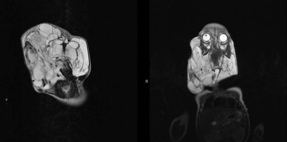 Lymphatische Malformation im Kopf- und Halsbereich