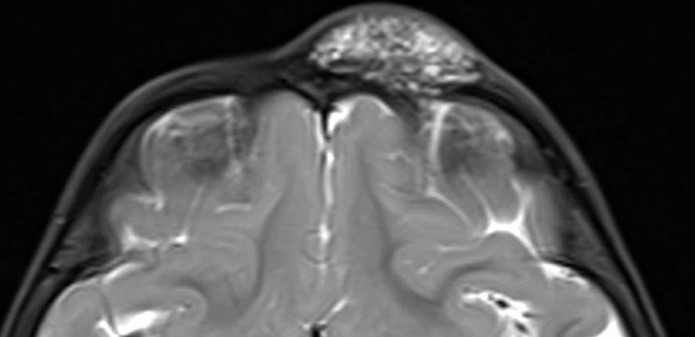 Lymphatische Malformation - MRT