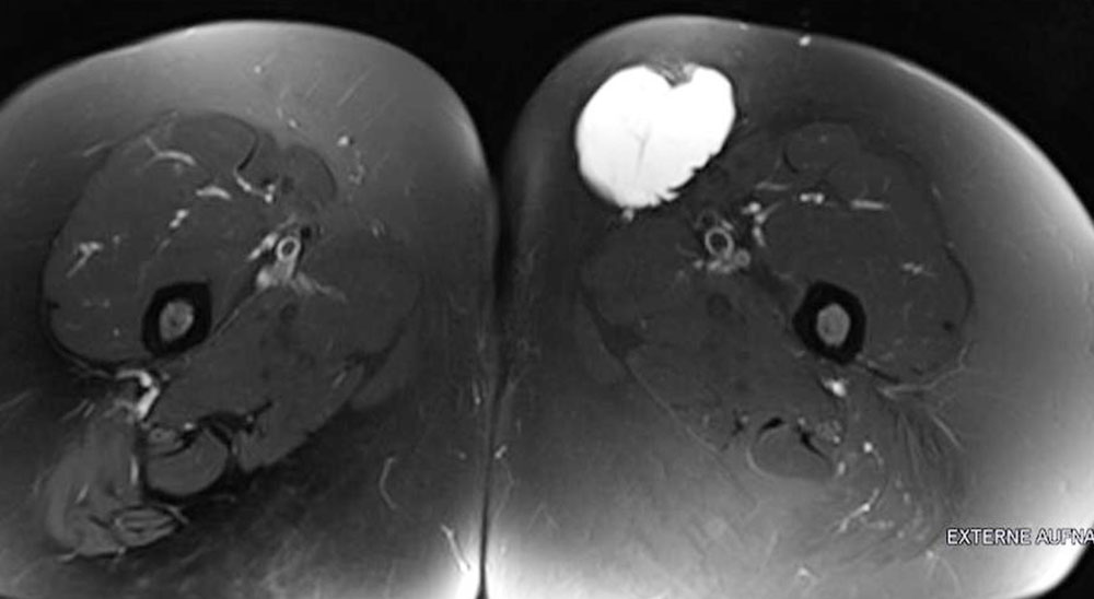 Makrozystische lymphatische Malformation - Oberschenkel - MRT