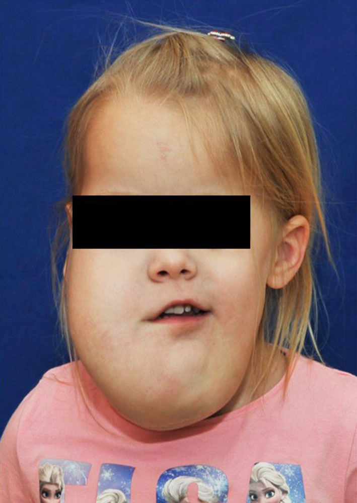 Lymphatischen Malformation im Kopf- und Halsbereich