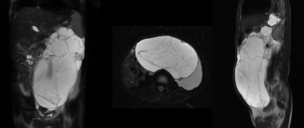 Retroperitoneale lymphatischen Malformation - Bauchraum - MRT