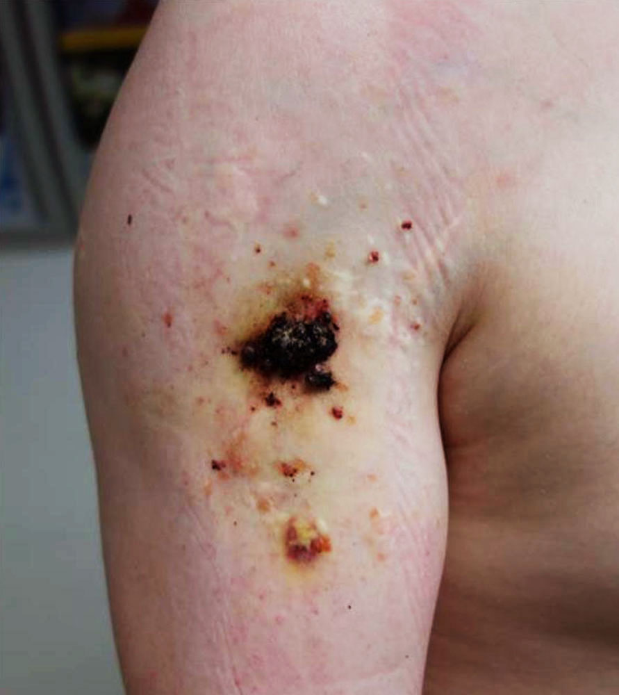 Lymphatische Malformation -  Bläschen auf Haut
