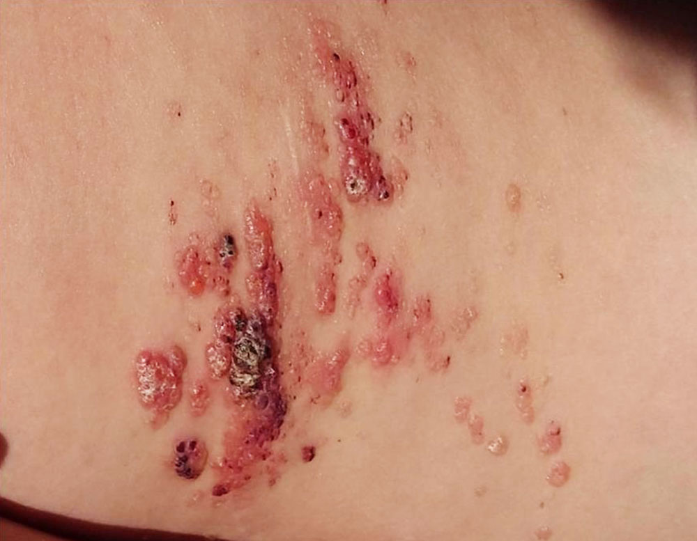 Lymphangioma circumscriptum  mit lymphgefüllten Vesikeln an Haut