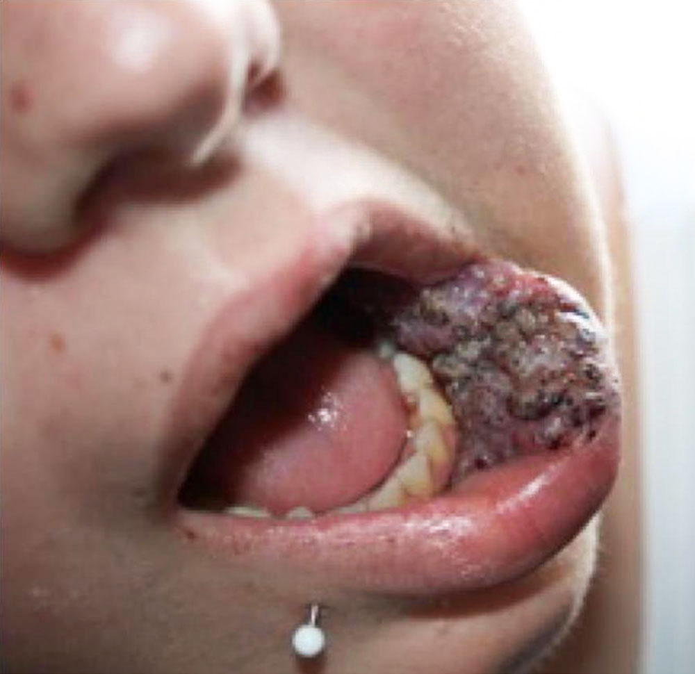 Lymphatischen Malformation auf Mukosa der Unterlippe