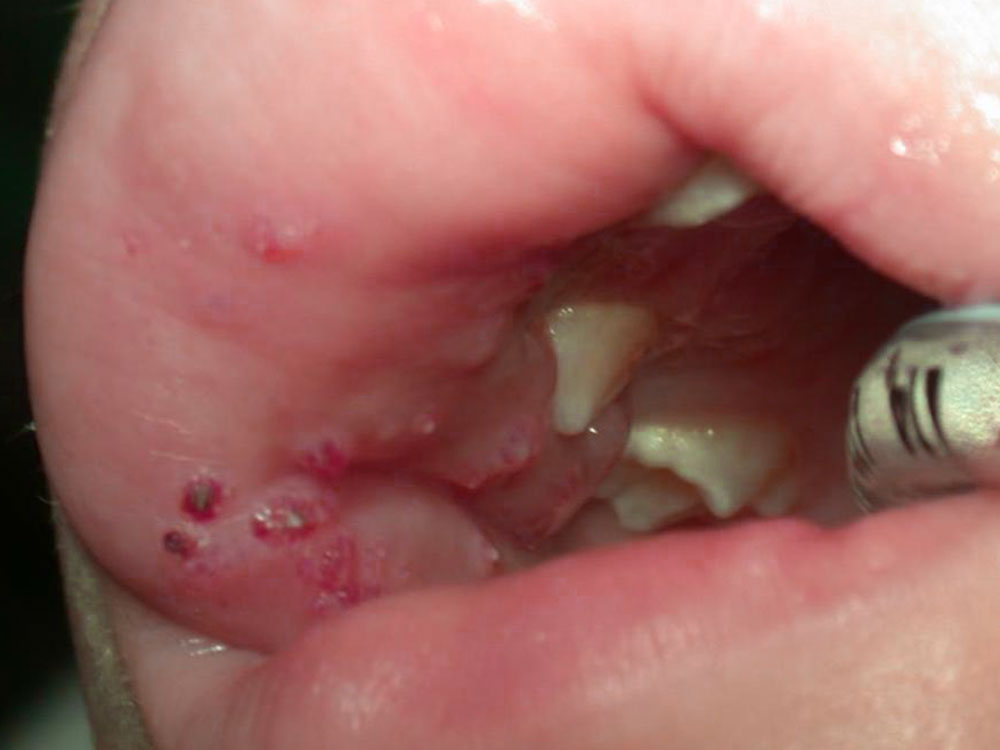  LM-Bläschen Mukosa - Lippe