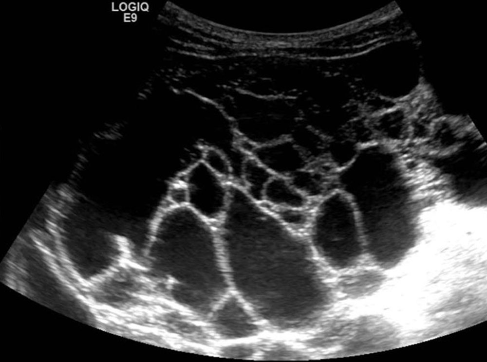 Sonographie - Lymphatische Malformation
