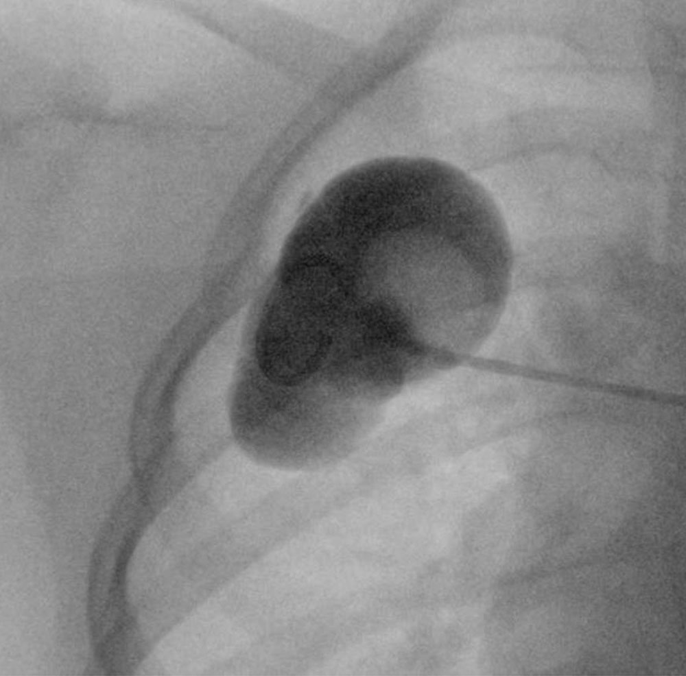 Makrozystische lymphatische Malformation - Thoraxwand