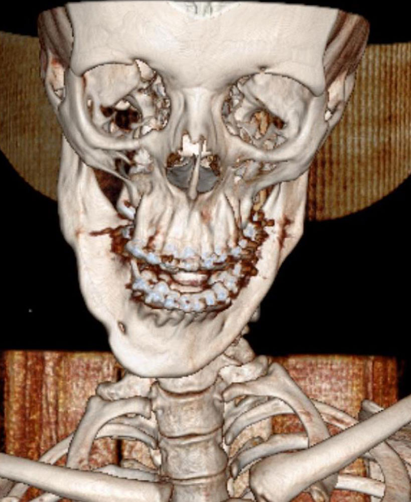3D-Rekonstruktion bei lymphatischer Malformation an Wange