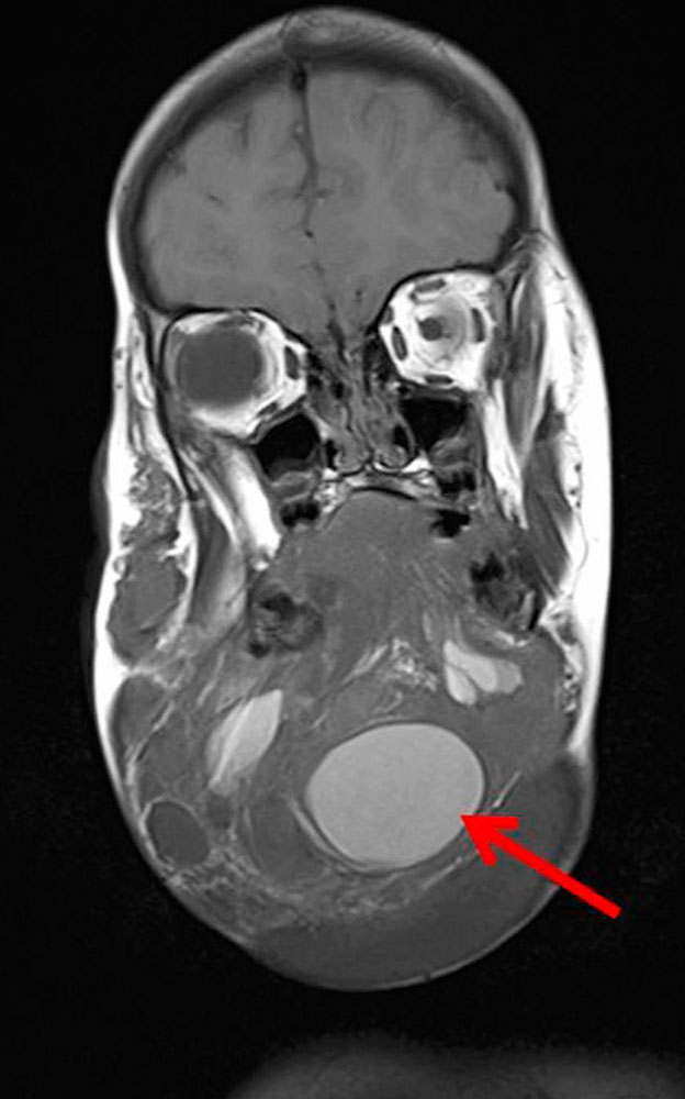 MRT – Makrozystische lymphatische Malformation am Hals