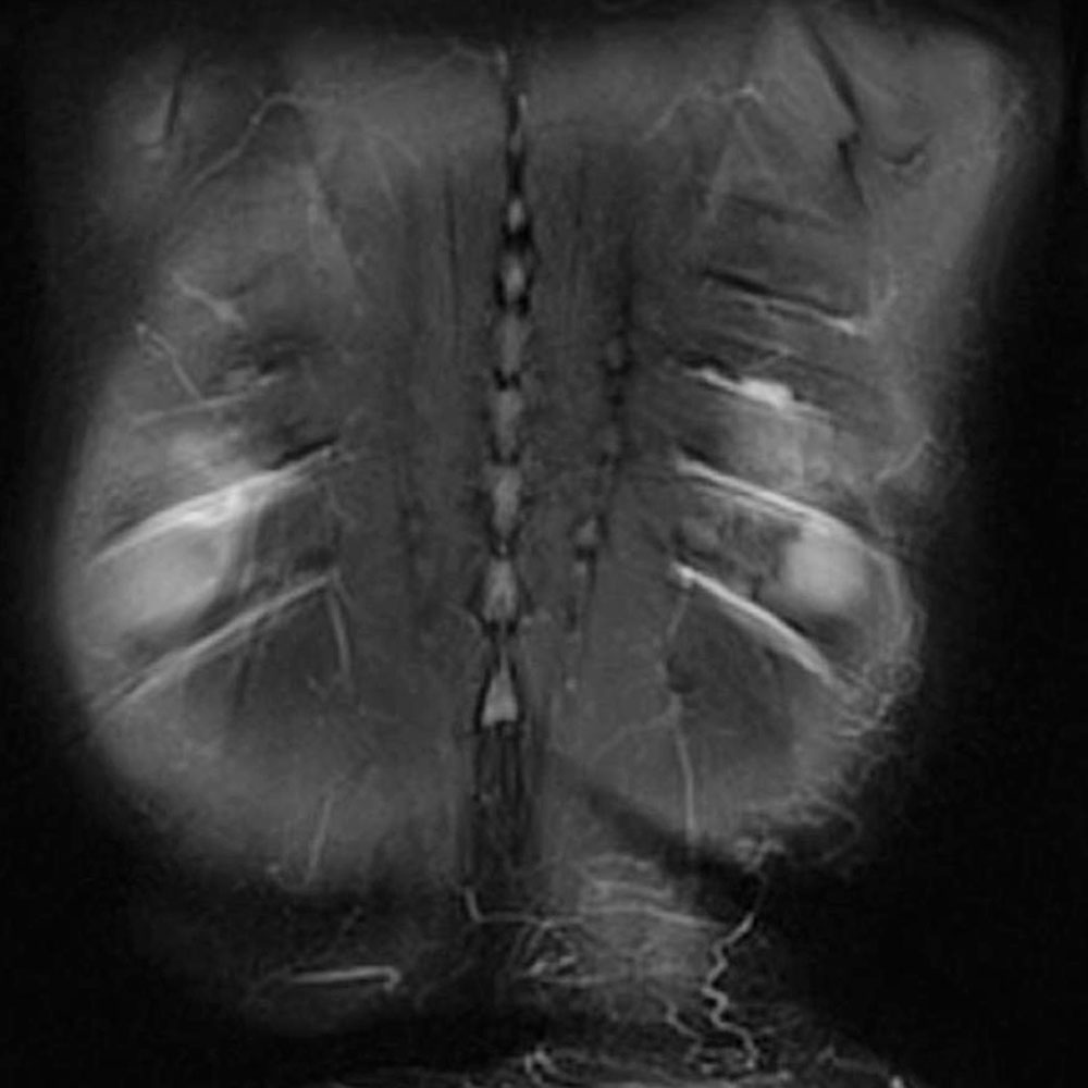 MRT – Lymphatische Kollateralwege