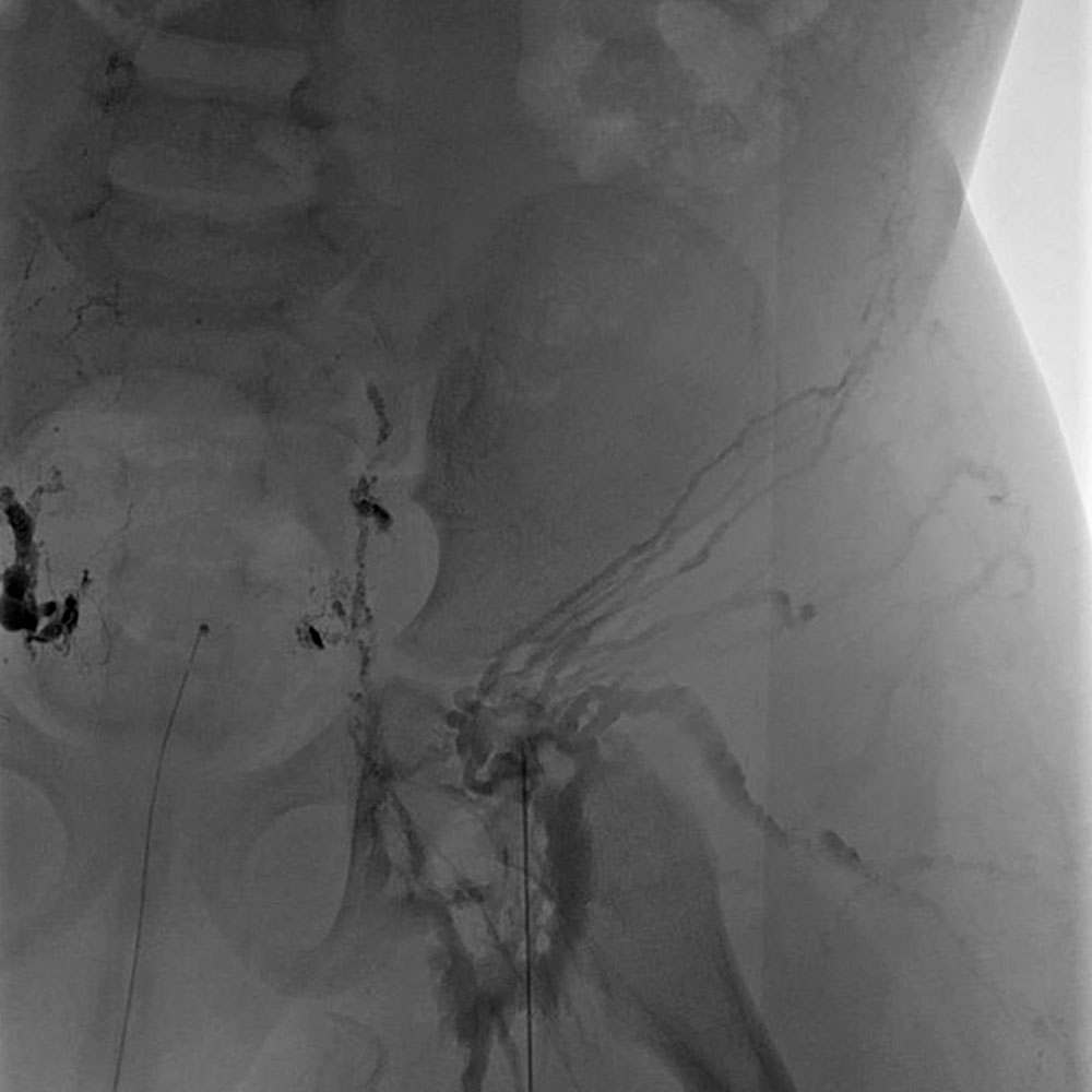 Intranodale Lymphangiographie über Leiste