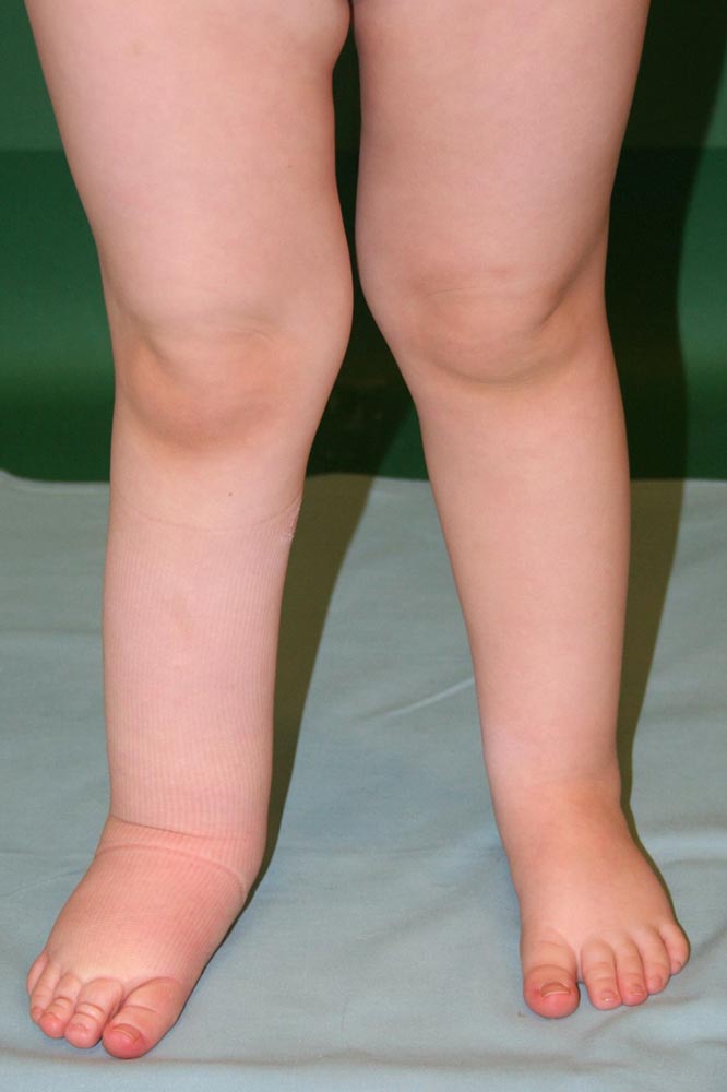 Patient mit primärem Lymphödem
