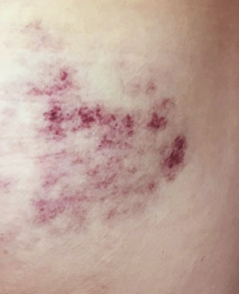 Kapilläre Malformation der Haut