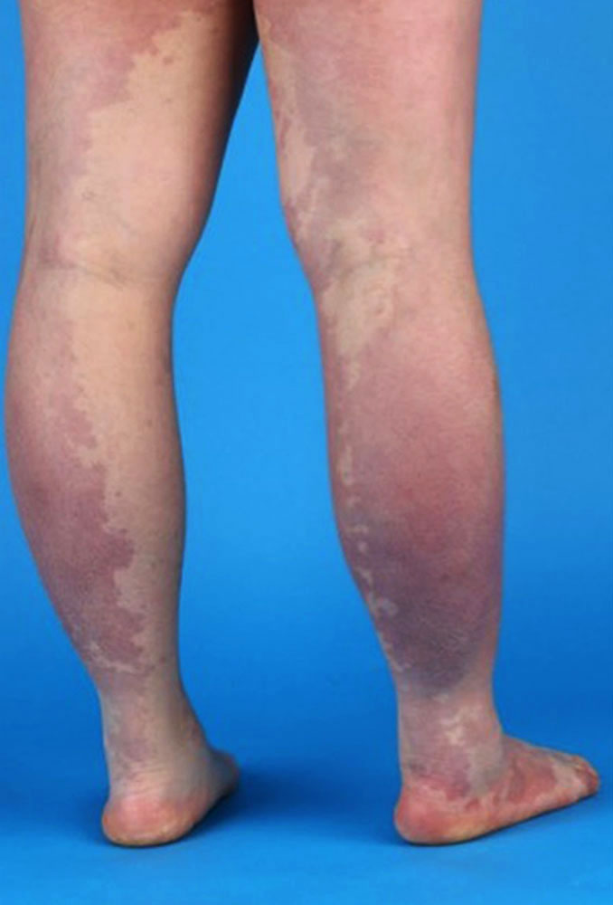 Kapilläre Malformation an beiden Beinen
