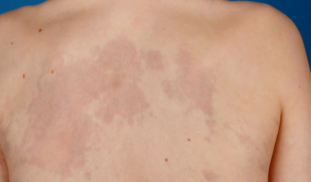 Kapilläre Malformation am Rücken