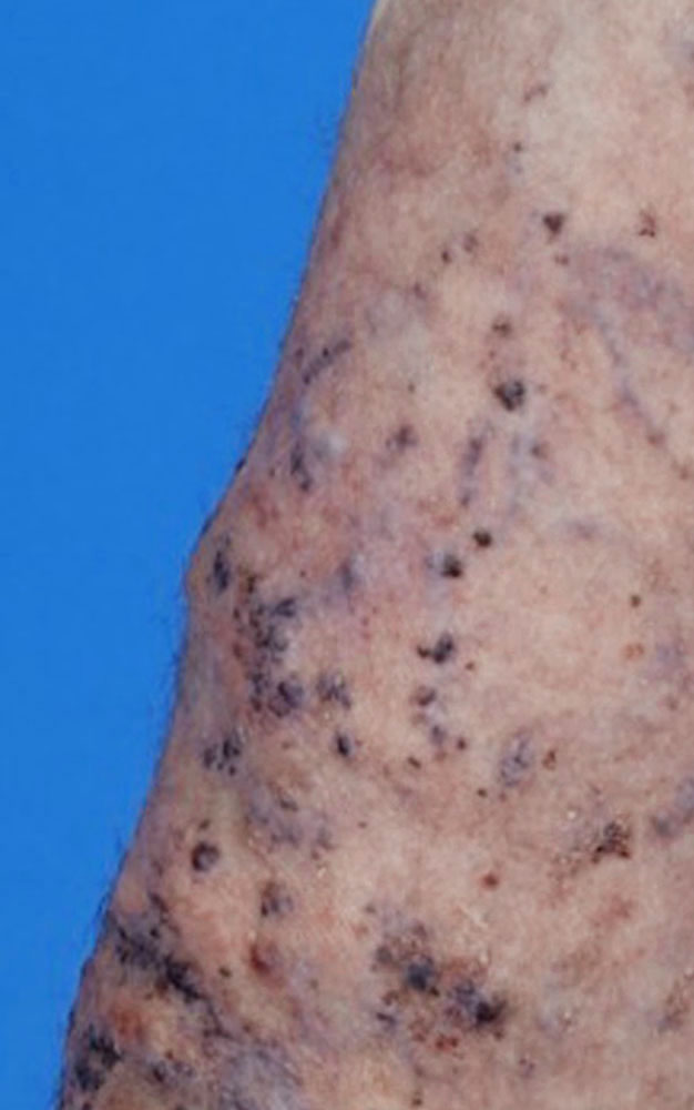 Kombinierte kapillär-venolymphatische Malformation bei Klippel-Trénaunay-Syndrom
