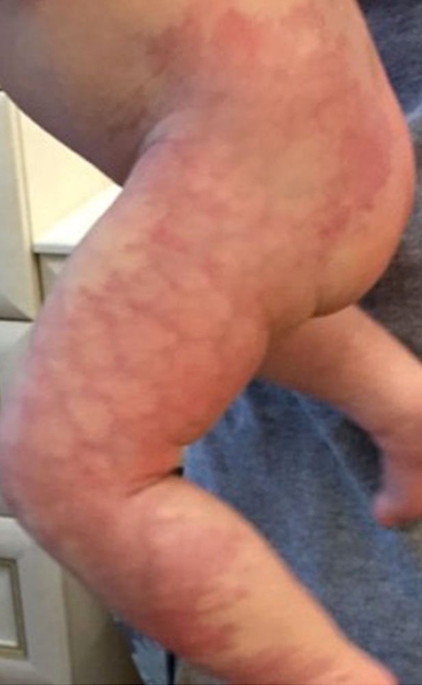 Kombination aus Kapillärer Malformation und CMTC bei Kleinkind