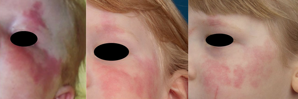 Kapilläre Malformation im Gesicht
