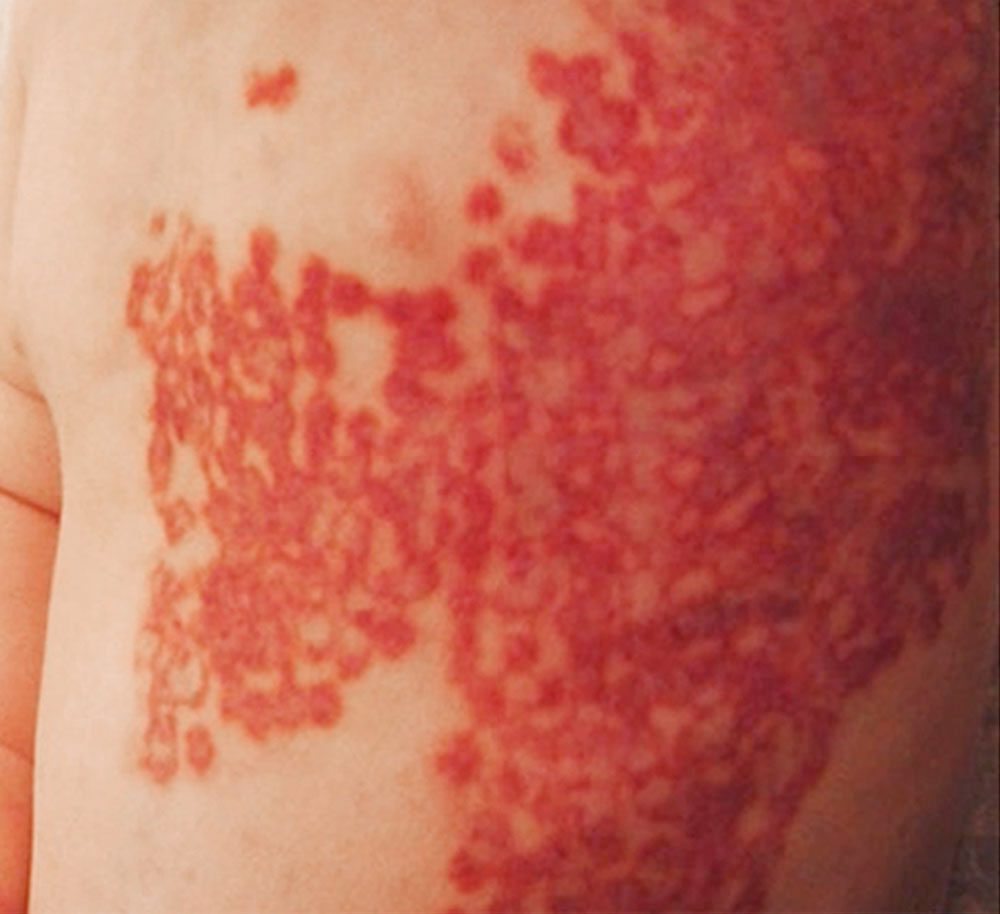 Kapilläre Malformation nach Laserung