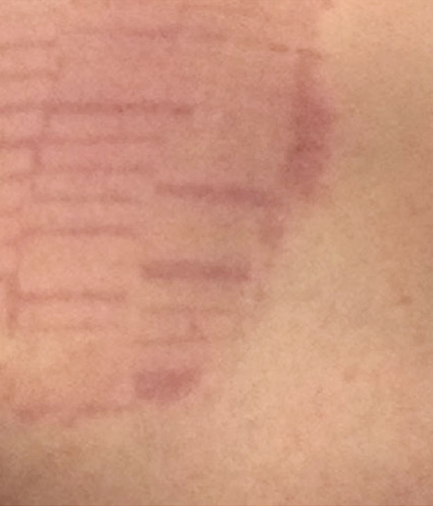 Kapilläre Malformation nach IPL-Laserung