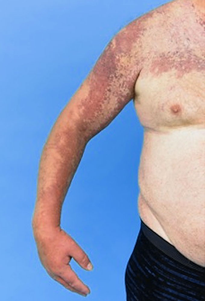 Kapillär-veno-lymphatische Malformation an Arm und Schulter