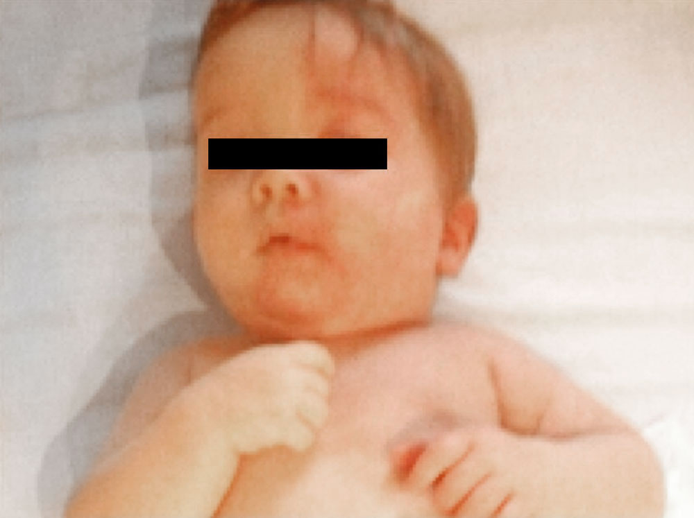 Säugling mit Sturge-Weber-Syndrom