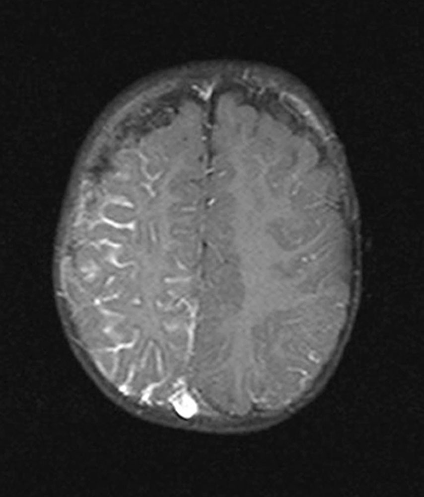 MRT - Leptomenigeale Angiomatose bei Sturge-Weber-Syndrom