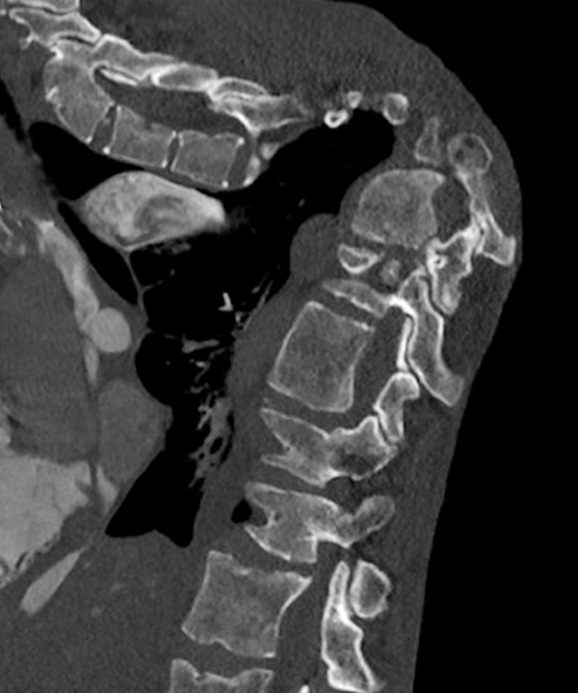 Computertomographie der Wirbelsäule bei Proteus-Syndrom