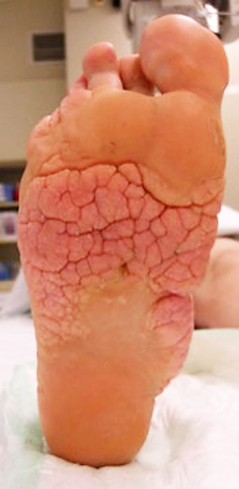 Cerebriformer Mixed Connective Tissue Nevus (Mokkasinsohle) bei Proteus-Syndrom