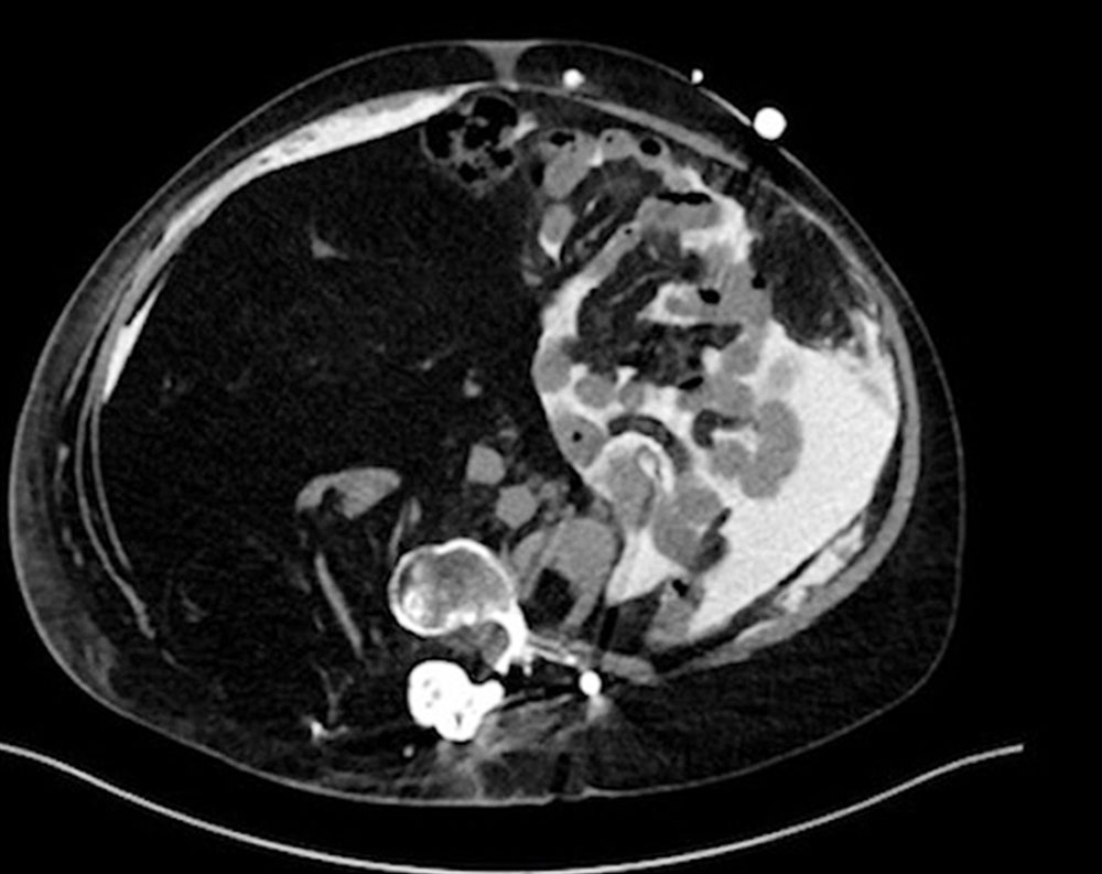 Computertomographie - Ausgeprägte intraabdominelle Hyperplasie
